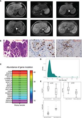 Case Report: Successful conversion and salvage resection of huge hepatocellular carcinoma with portal vein tumor thrombosis and intrahepatic metastasis via sequential hepatic arterial infusion chemotherapy, lenvatinib plus PD-1 antibody followed by simultaneous transcatheter arterial chemoembolization, and portal vein embolization